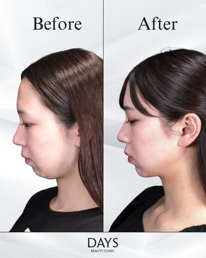 小顔　症例　20代女性