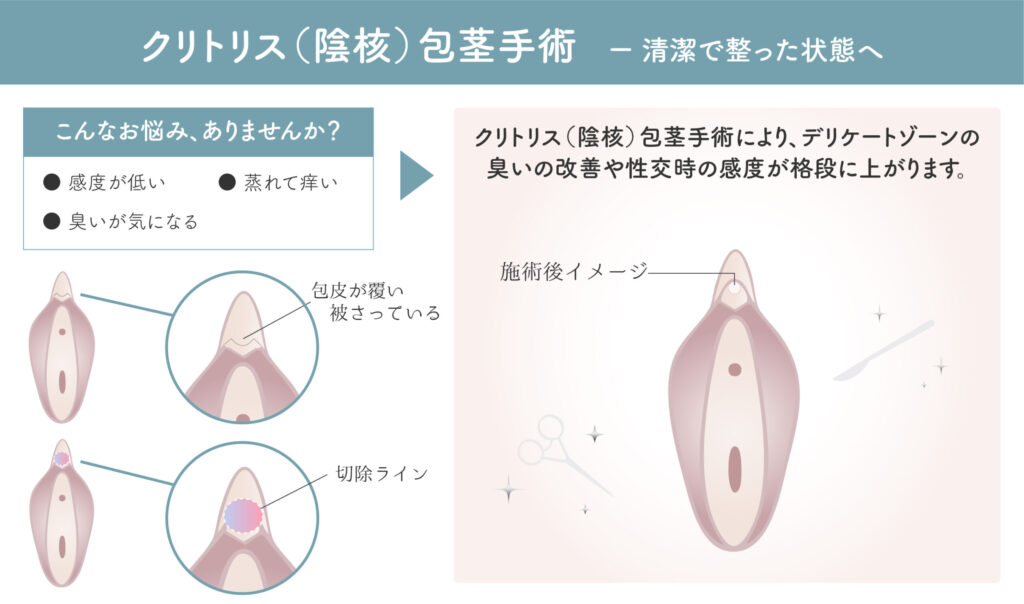 クリトリス（陰核）包茎手術