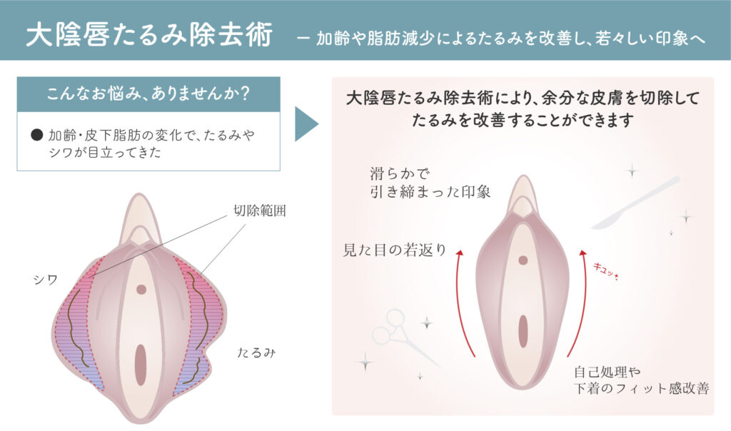 大陰唇たるみ除去術