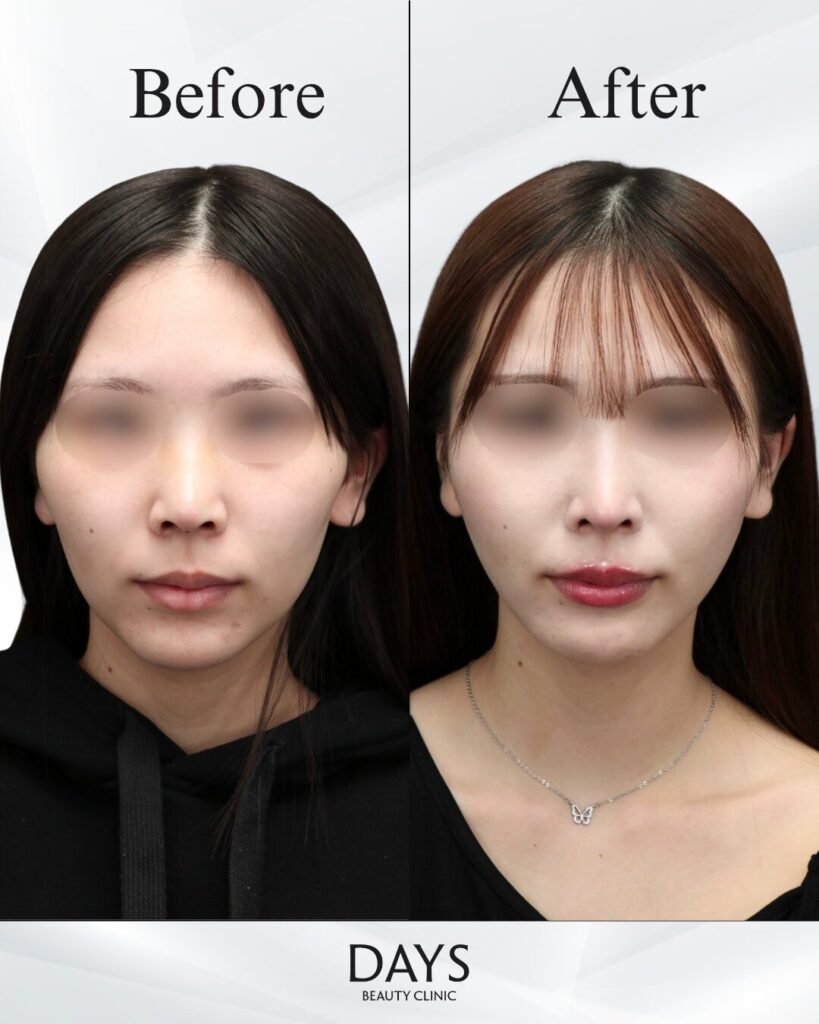 小顔　症例　20代女性