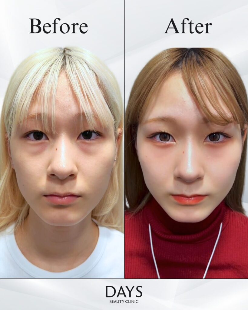 クマ取り　症例　20代女性