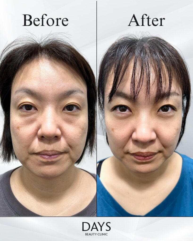 クマ取り　症例　50代女性