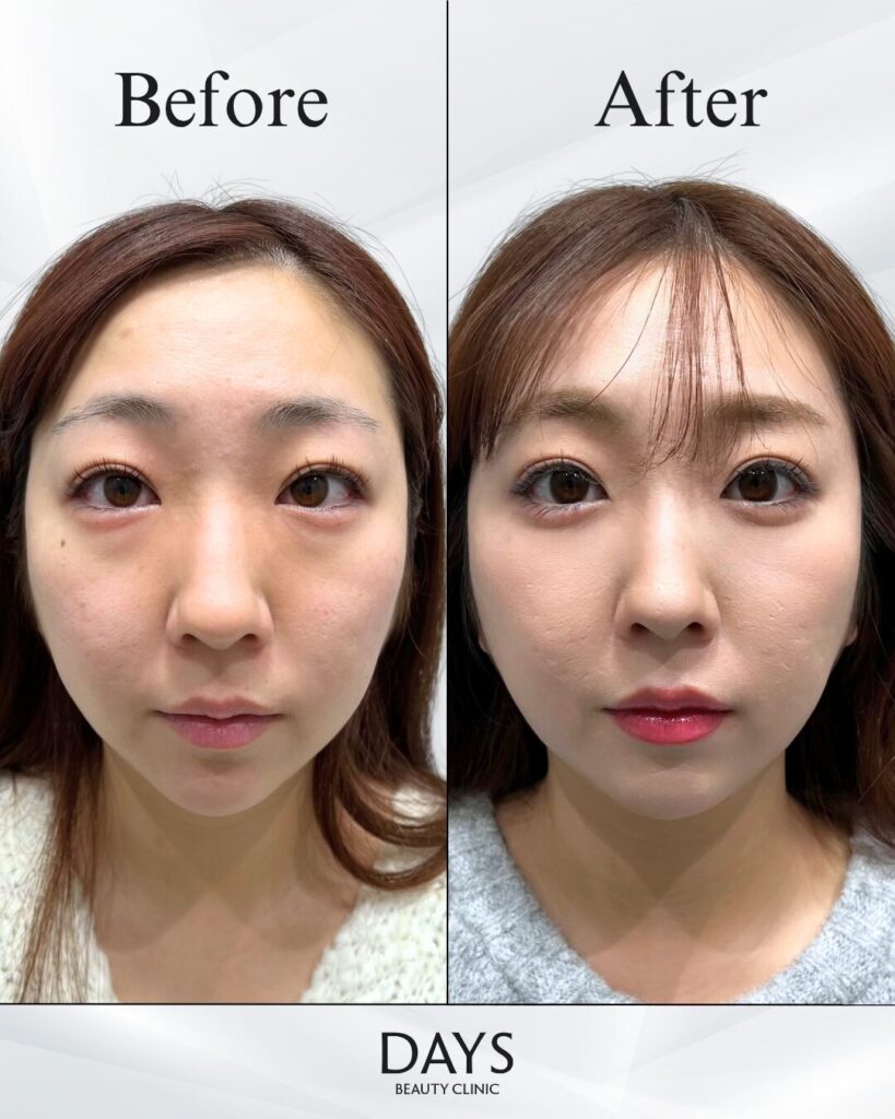 クマ取り　症例　20代女性