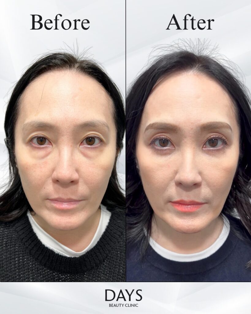 クマ取り　症例　40代女性