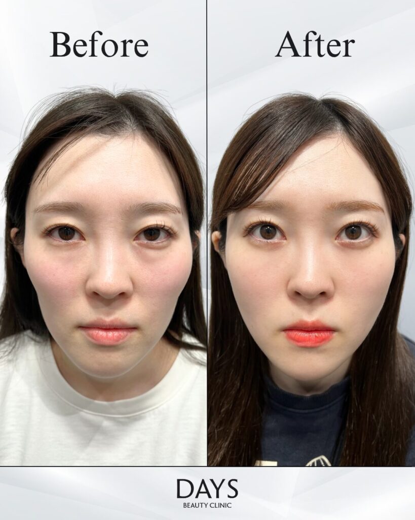 クマ取り　症例　20代女性