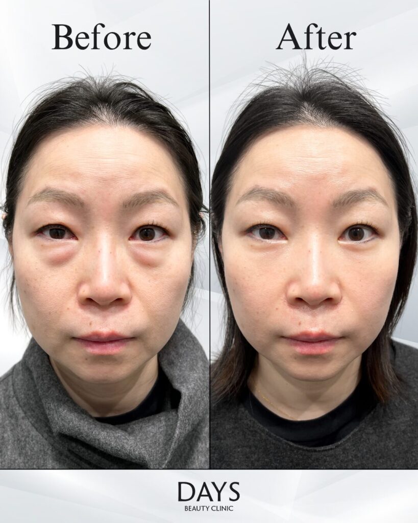 クマ取り　症例　40代女性