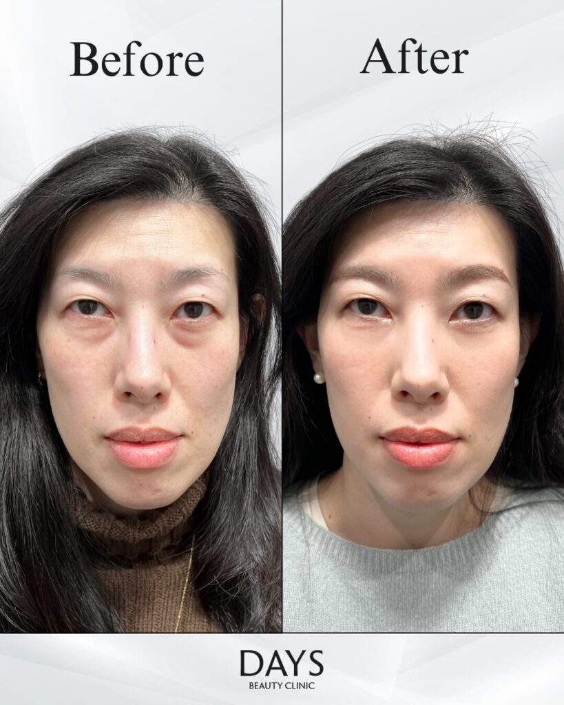 裏ハムラ　症例　40代女性