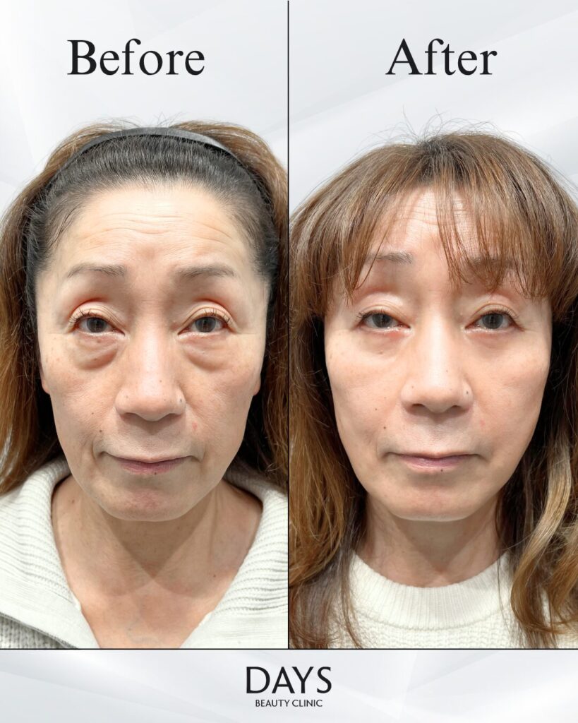 裏ハムラ　症例　50代女性