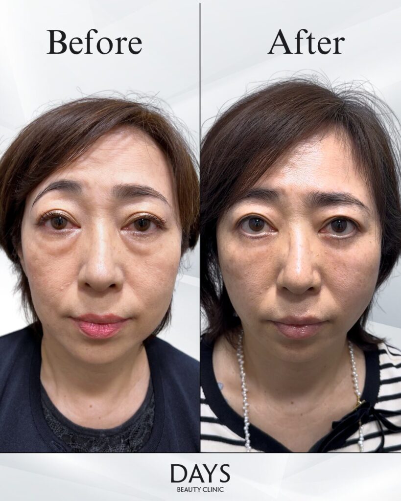 クマ取り　症例　50代女性