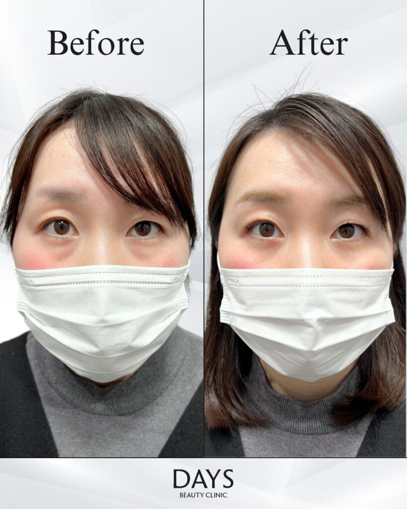 裏ハムラ　症例　20代女性