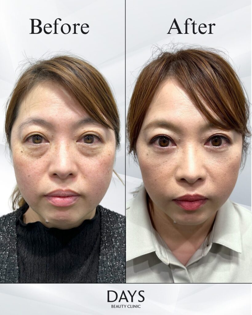 クマ取り　症例　40代女性