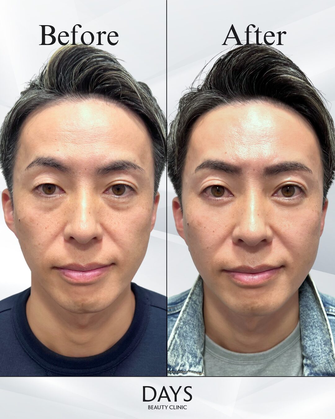 クマ取り　症例　40代男性