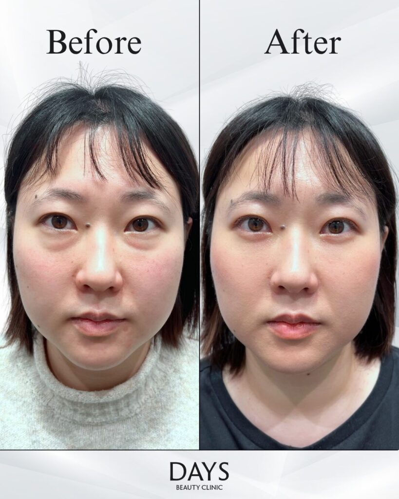 クマ取り　症例　30代女性