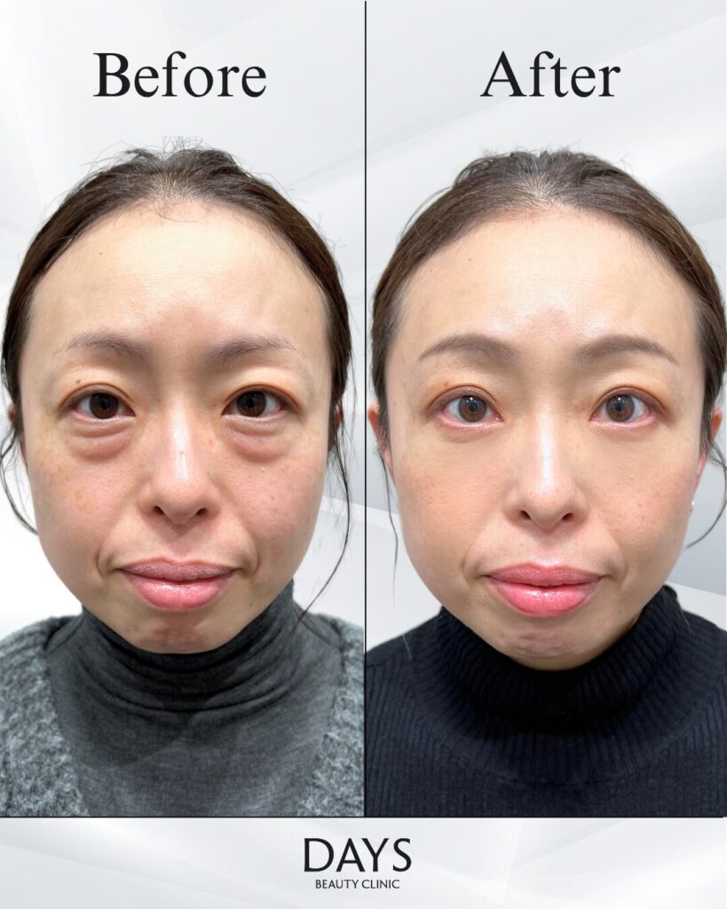 クマ取り　症例　40代女性