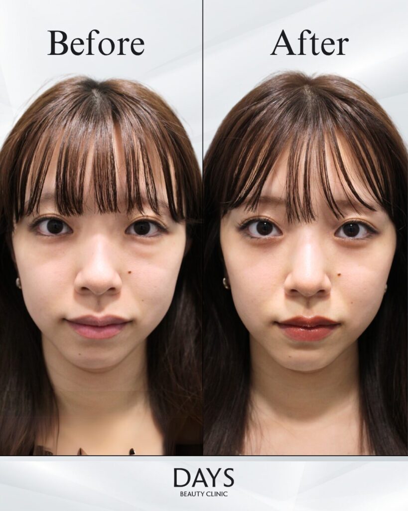 クマ取り　症例　20代女性