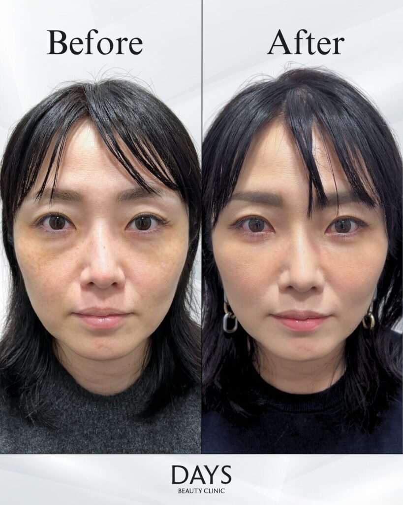 クマ取り　症例　30代女性