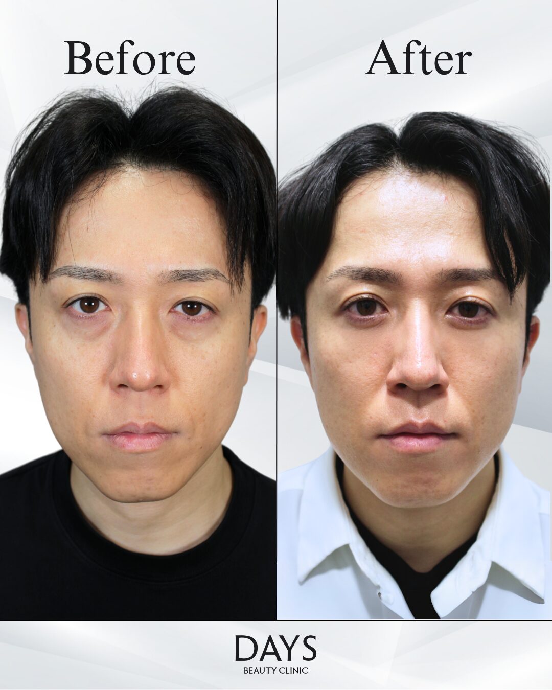 クマ取り　症例　30代男性