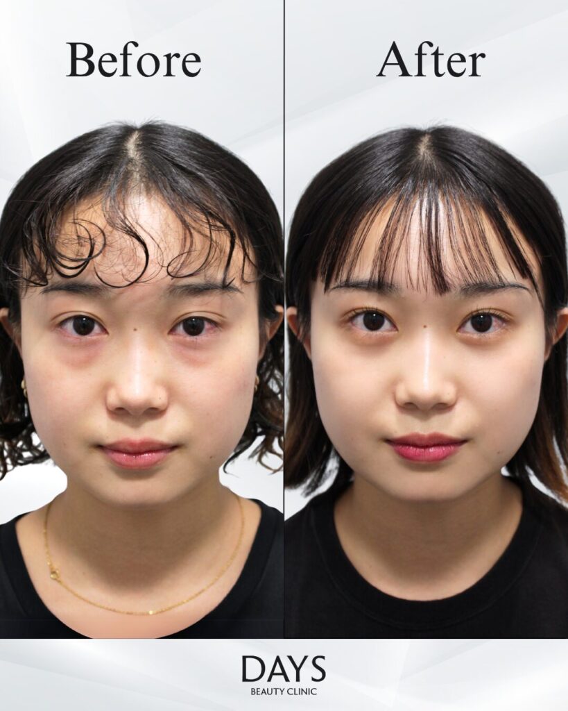 クマ取り　症例　20代女性