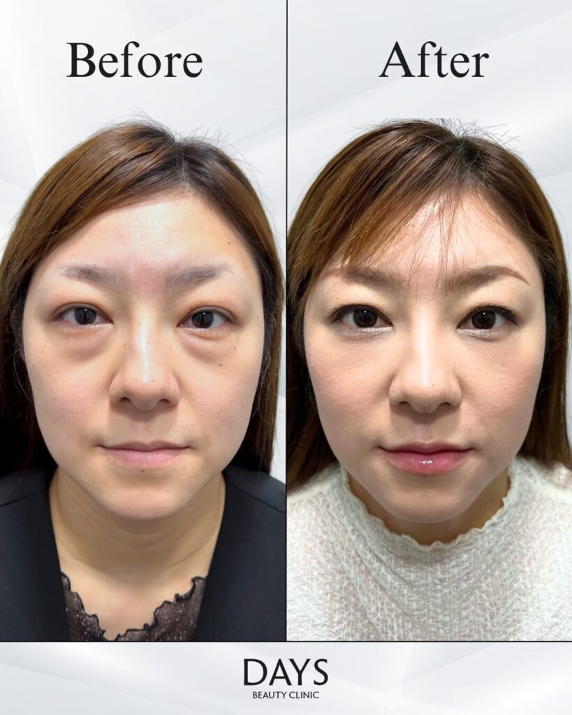 クマ取り　症例　30代女性