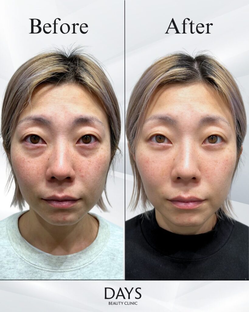 クマ取り　症例　30代女性