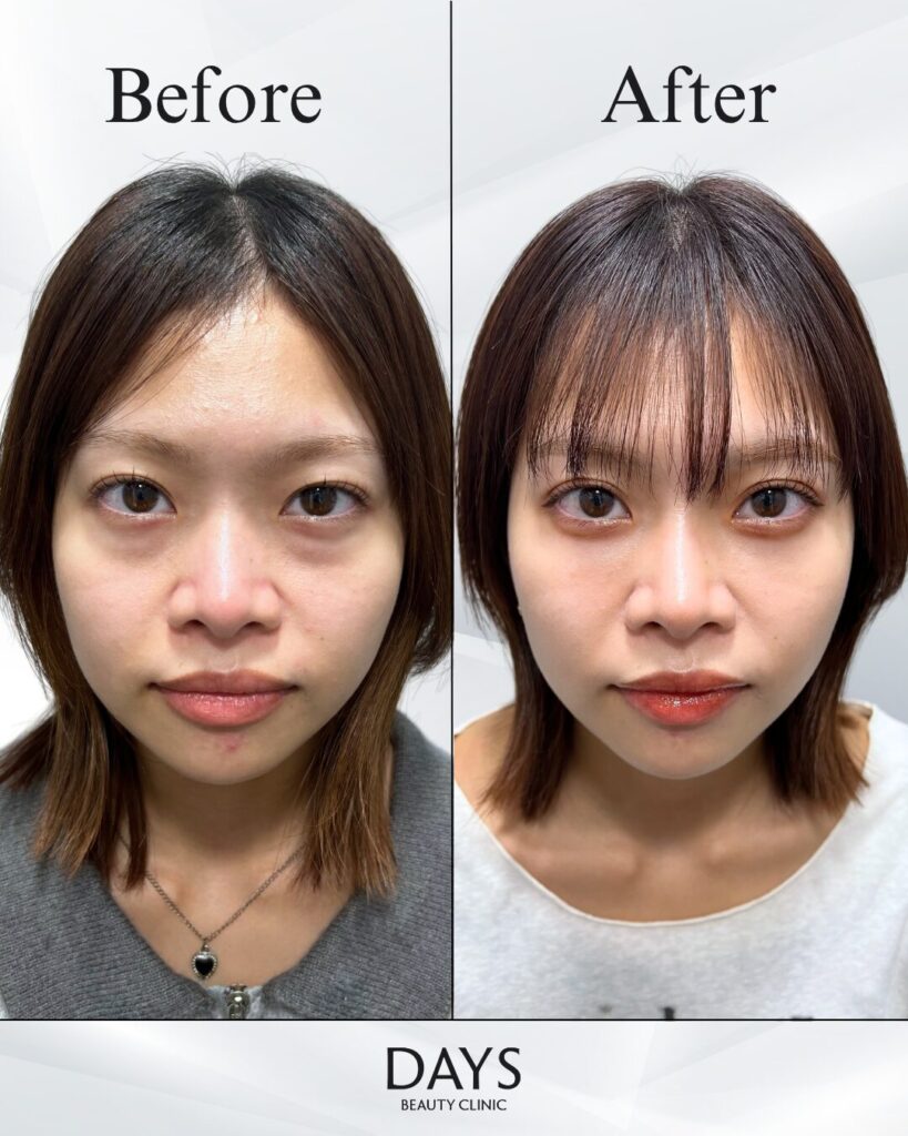 クマ取り　症例　20代女性