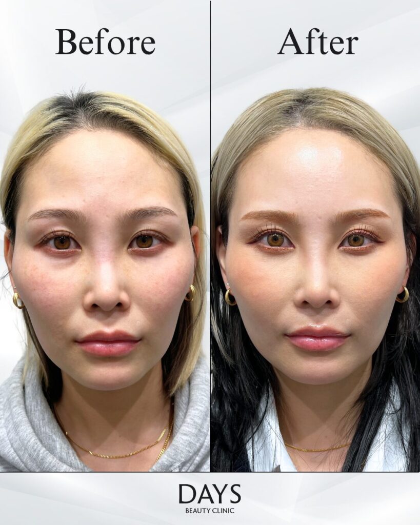 クマ取り　症例　30代女性