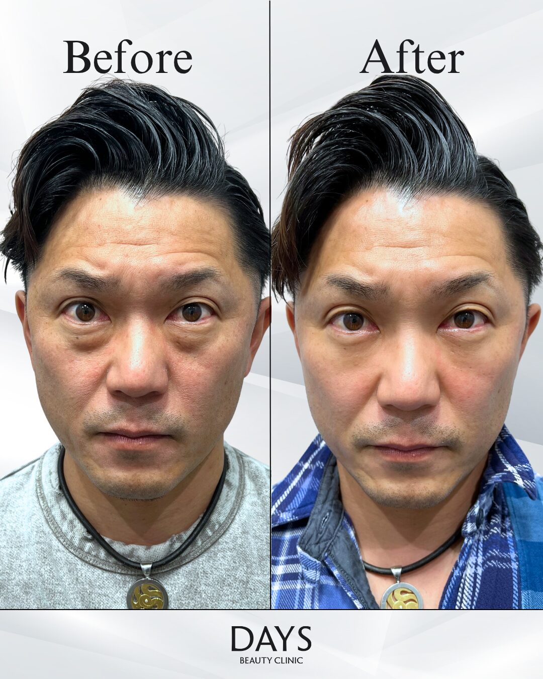 クマ取り　症例　40代男性