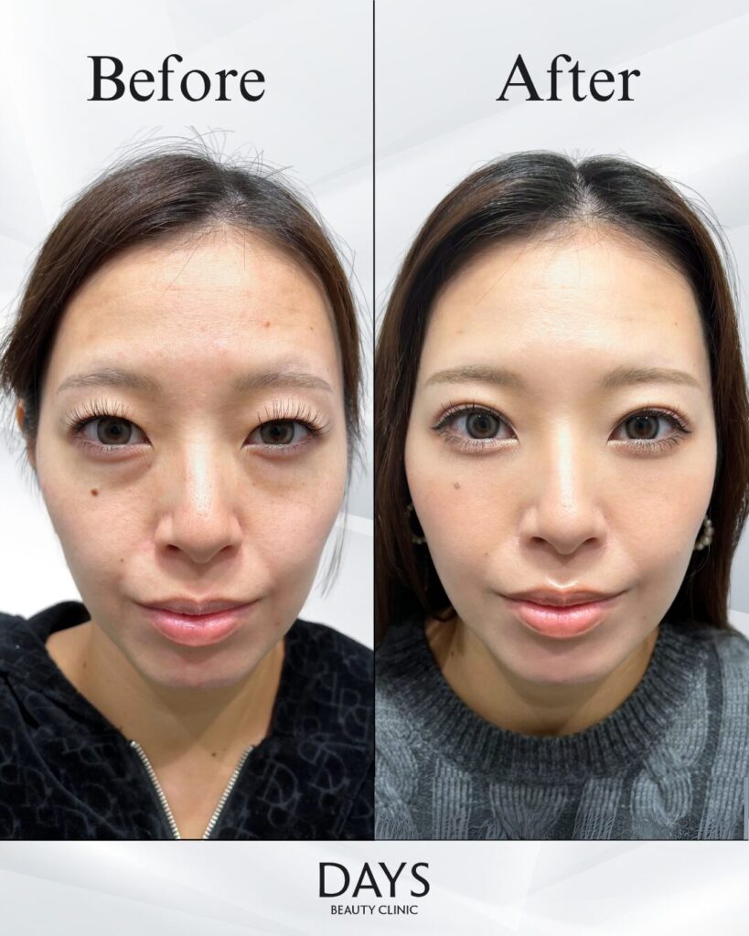 クマ取り　症例　20代女性