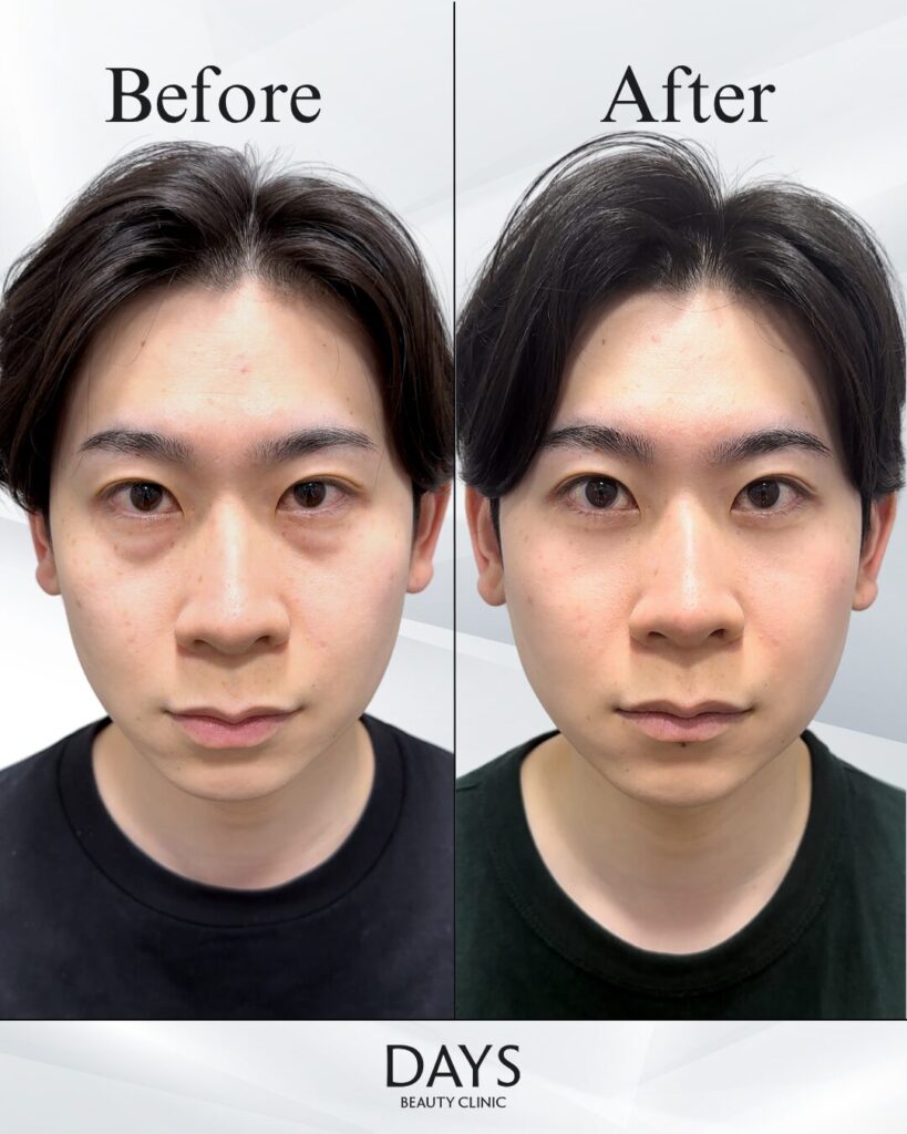 クマ取り　症例　20代男性