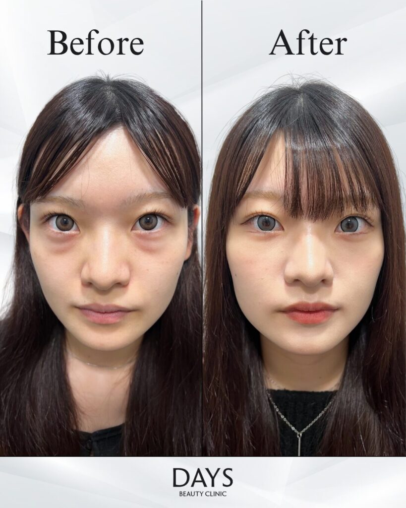 クマ取り　症例　20代女性