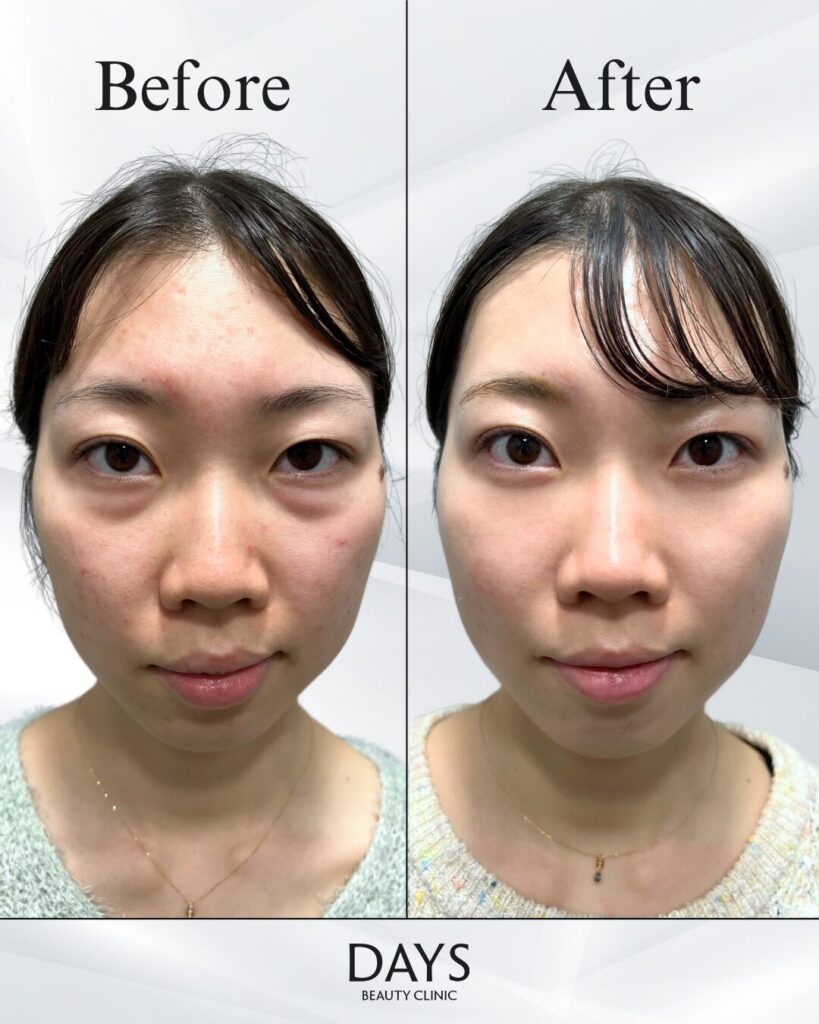 クマ取り　症例　20代女性