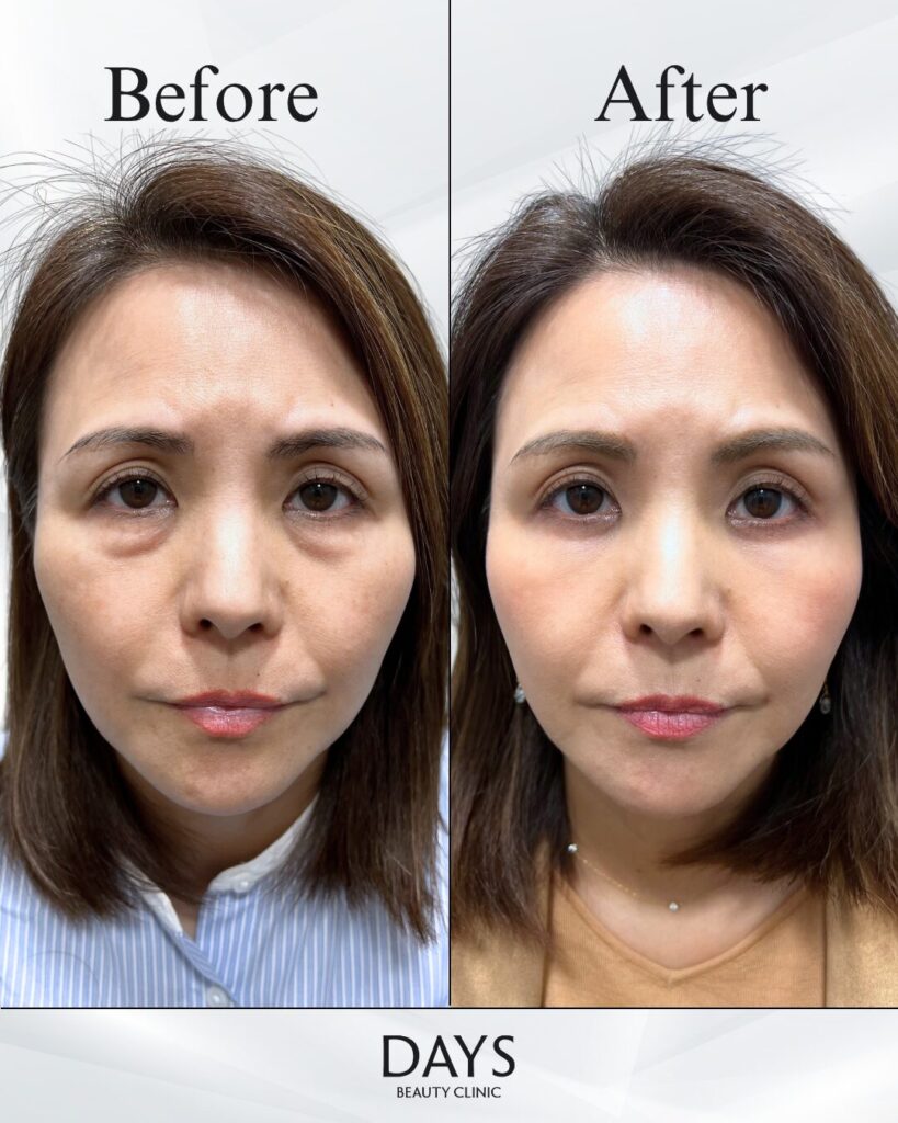 クマ取り　症例　40代女性