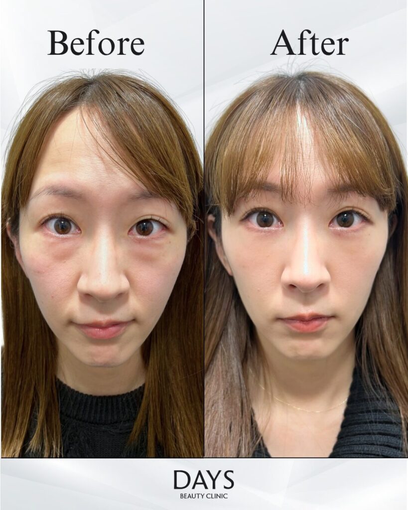 クマ取り　症例　30代女性