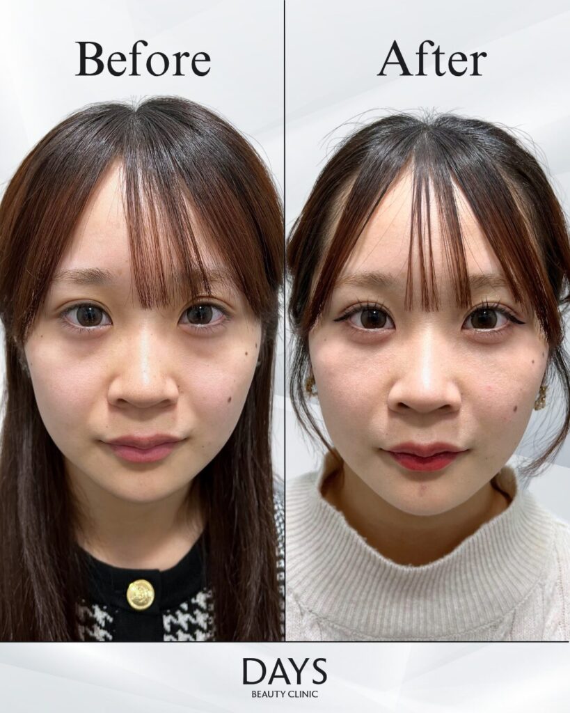 クマ取り　症例　20代女性