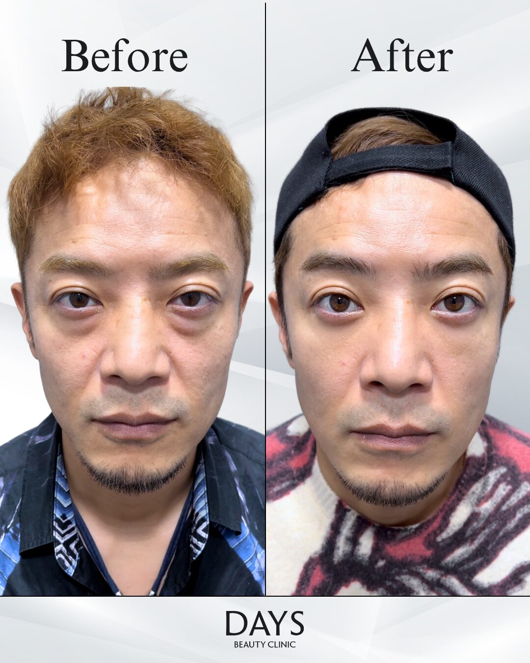 クマ取り　症例　40代男性