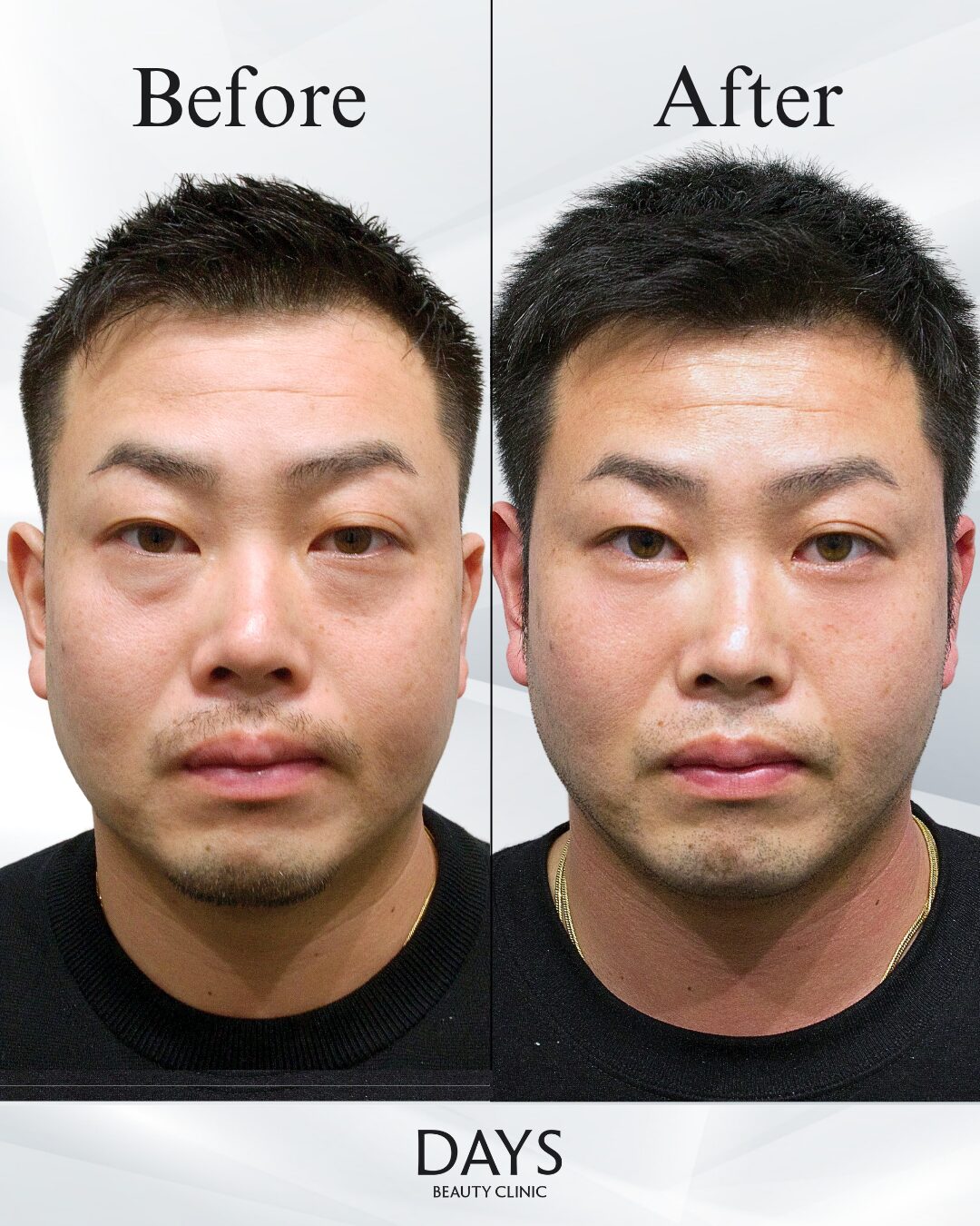 裏ハムラ　症例　30代男性