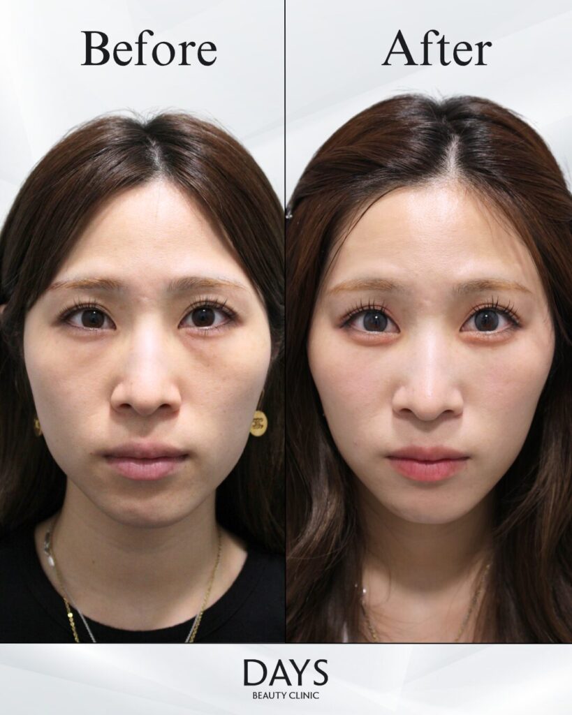 クマ取り　症例　30代女性