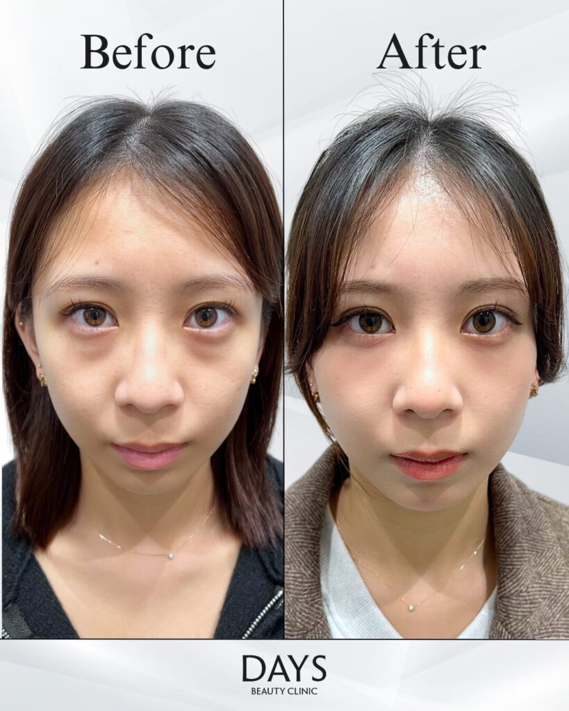 クマ取り　症例　20代女性