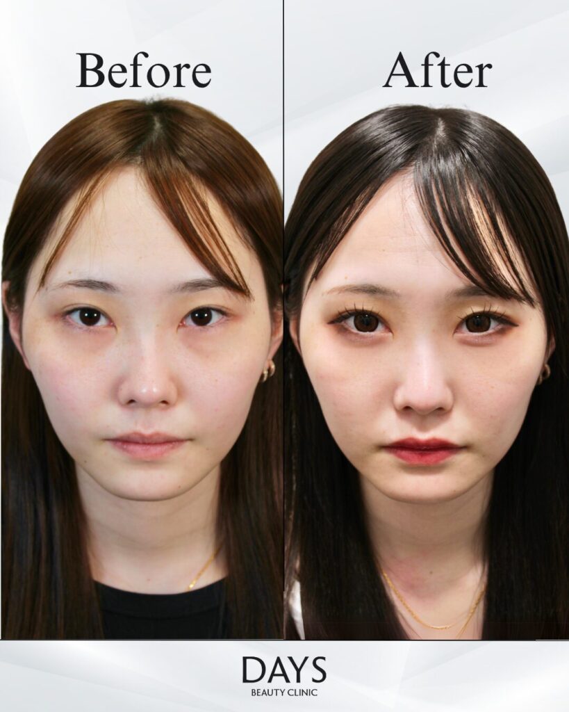 クマ取り　症例　20代女性