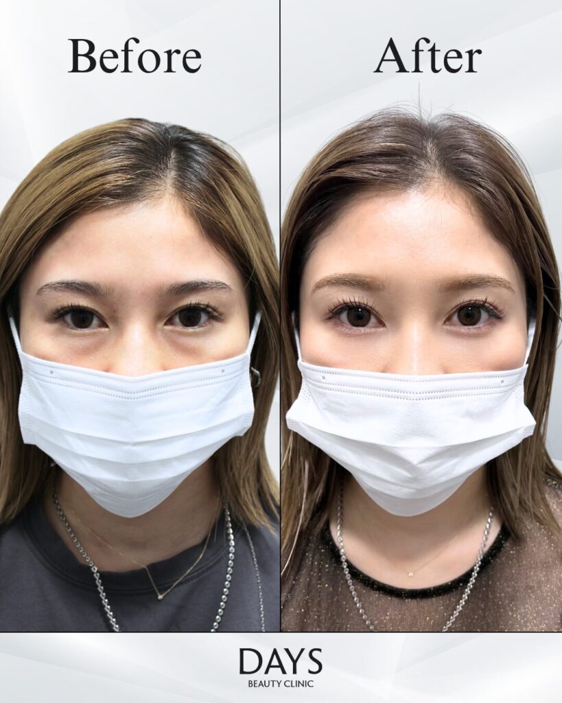 クマ取り　症例　30代女性