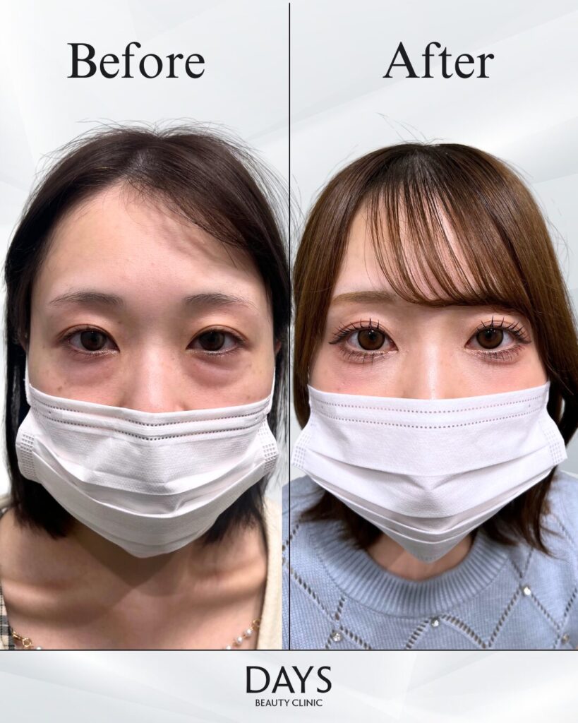 裏ハムラ　症例　20代女性