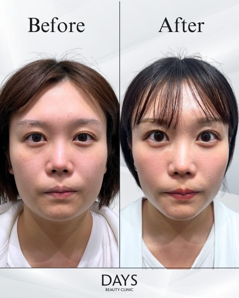 裏ハムラ　症例　20代女性