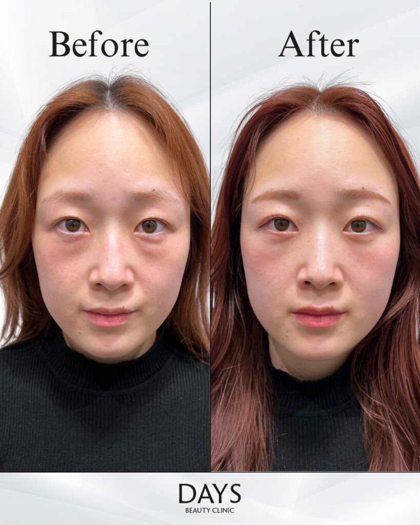 裏ハムラ　症例　20代女性