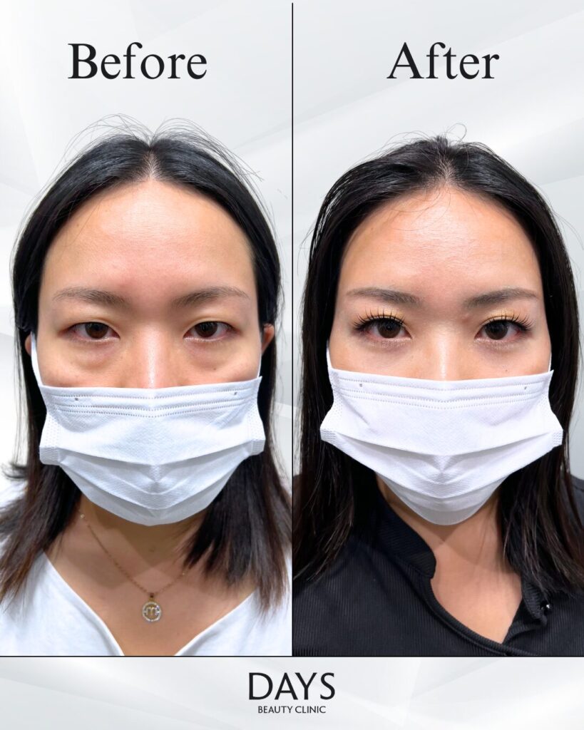 クマ取り　症例　30代女性