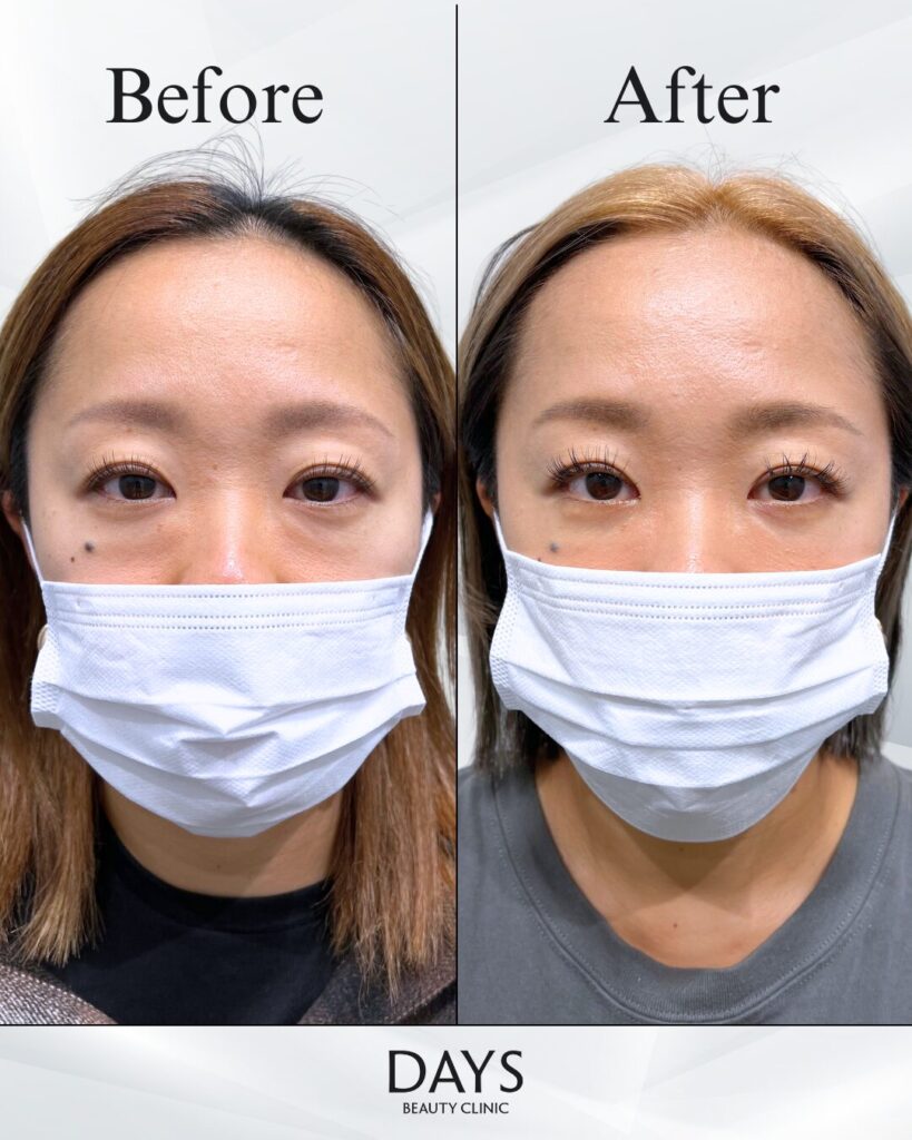 クマ取り　症例　30代女性