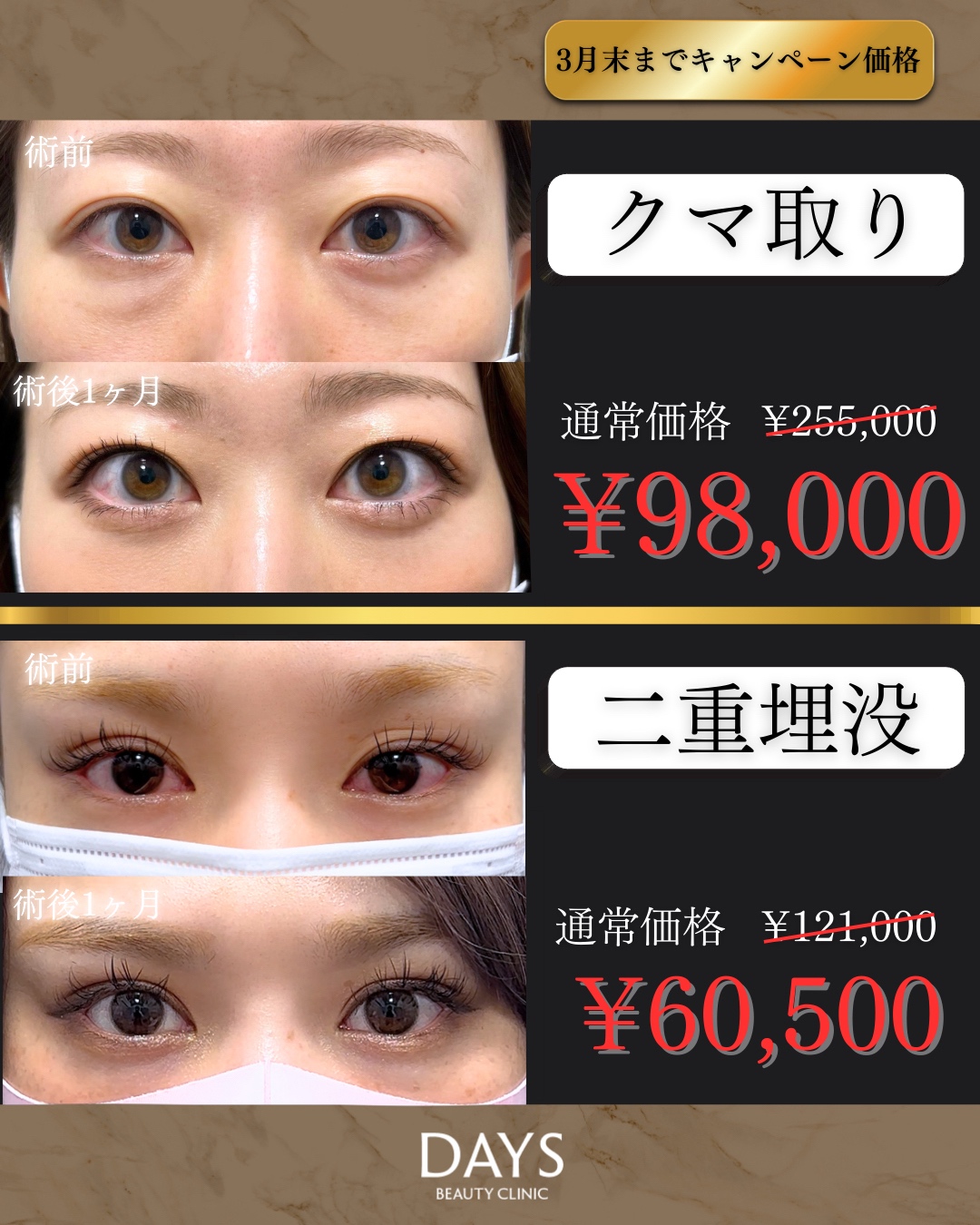 クマ取り・二重2603