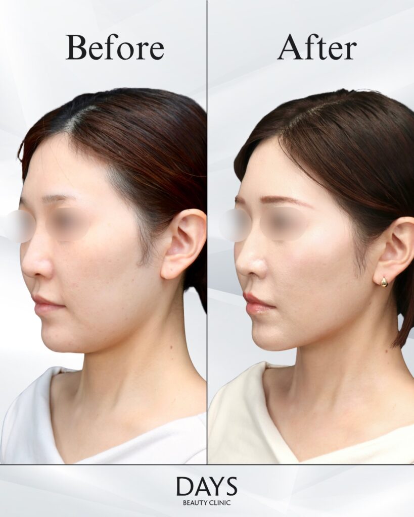 小顔　症例　30代女性