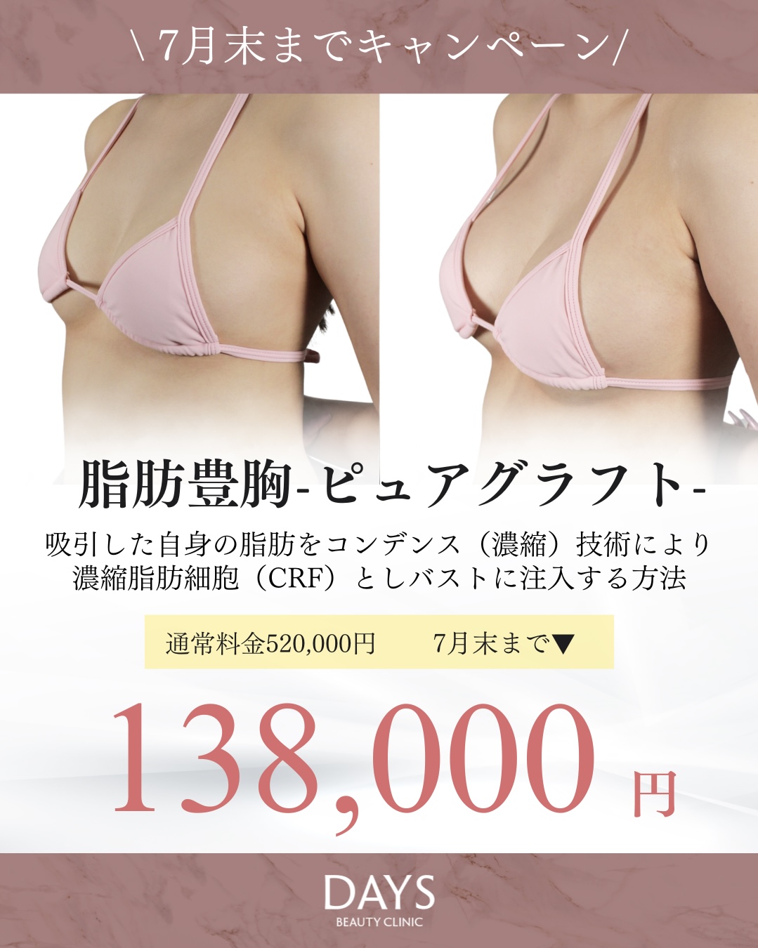 脂肪豊胸01