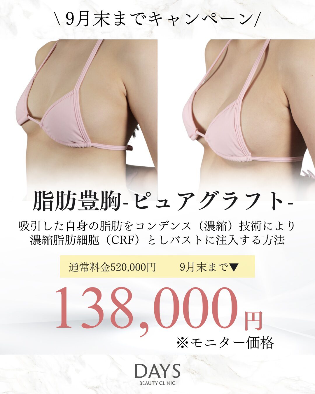 脂肪豊胸2509