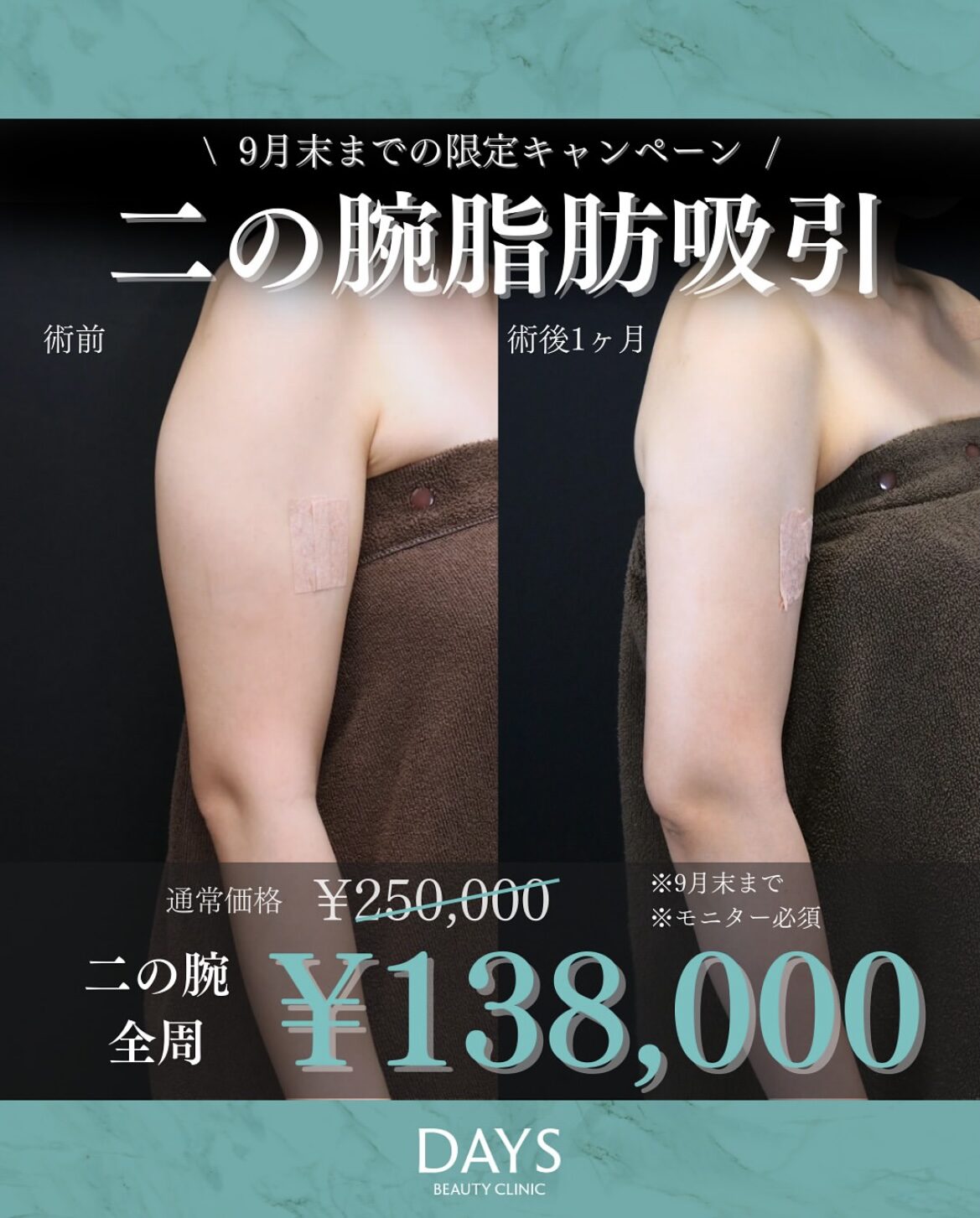 二の腕脂肪吸引2509